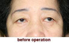 plastic-surgery-blepharoplasty